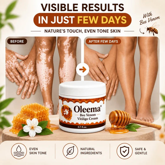 MD Oleema Advanced Vitiligo Restore Cream ✨ | Buy 1 Get 1 Free