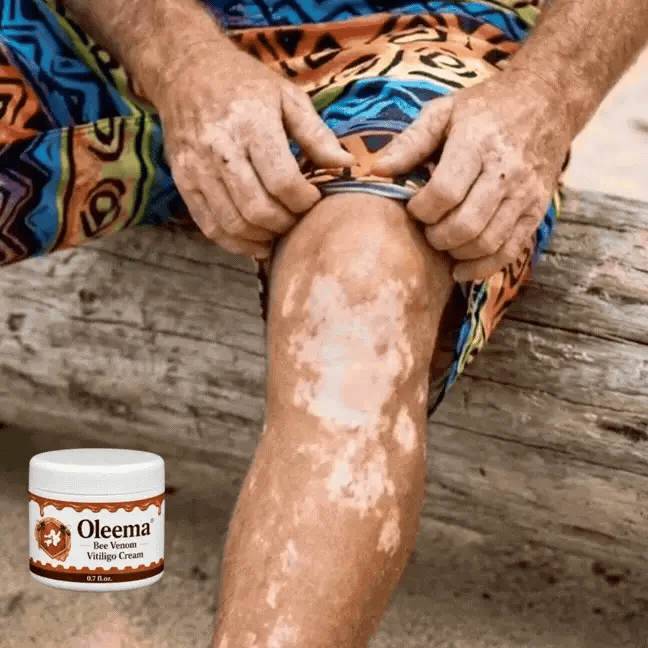 MD Oleema Advanced Vitiligo Restore Cream ✨ | Buy 1 Get 1 Free Promo Banner