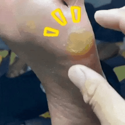 MD Corn Removal gel | Targeted Care for Softer, Smoother Feet. Promo Banner