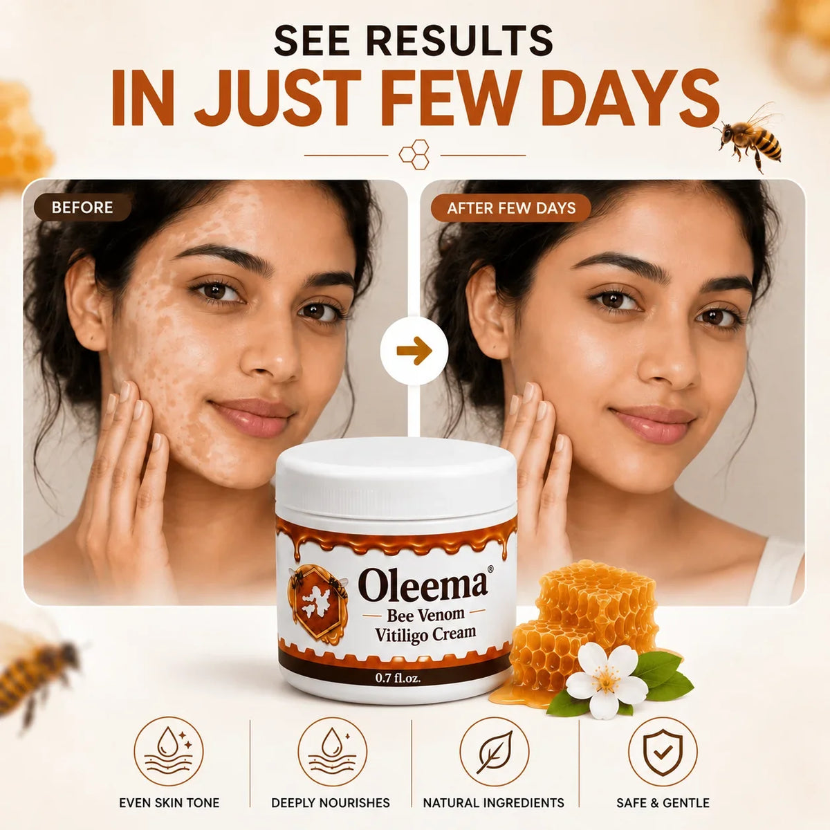 MD Oleema Advanced Vitiligo Restore Cream ✨ | Buy 1 Get 1 Free Promo Banner