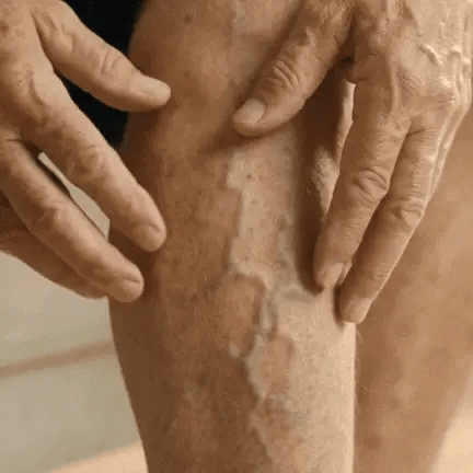 MD Varicose vein spray Targeted Care. Easy Application. Better Leg Comfort.