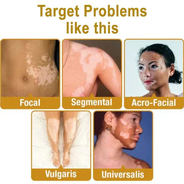 MD Oleema Advanced Vitiligo Restore Cream ✨ | Buy 1 Get 1 Free Promo Banner